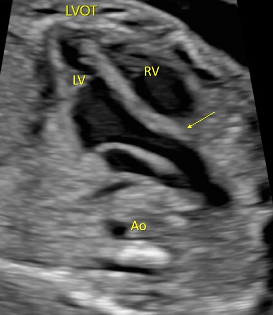 胎児の左室流出路断面の超音波画像。左室（LV）から起こる大動脈（LVOT）、右室（RV）、下行大動脈（Ao）が示され、心室中隔と大動脈前壁が連続する部位に矢印が付けられている